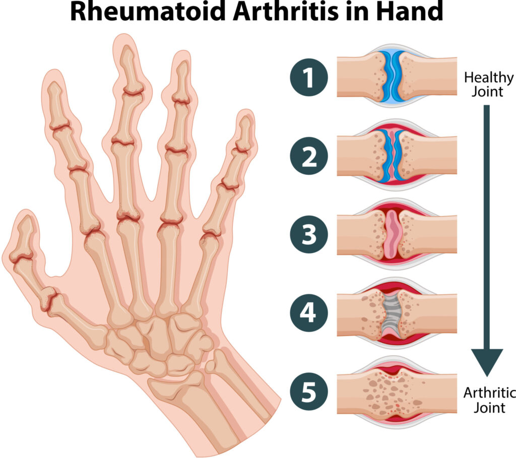 Rheumatoid Arthritis Awareness Day 2026: Why It Deserves Our Attention